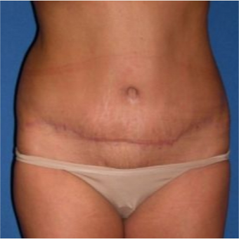 35-44 year old woman treated with Tummy Tuck after 3009727