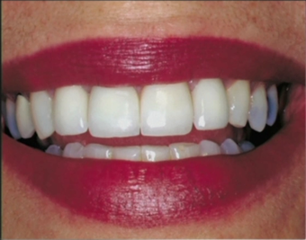 Repaired and replaced old broken dental crowns after 1173285