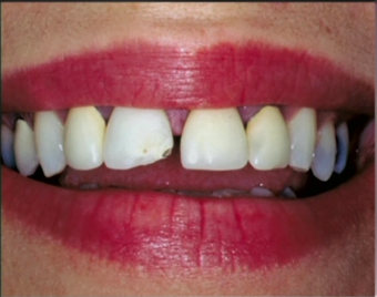 Repaired and replaced old broken dental crowns before 1173285