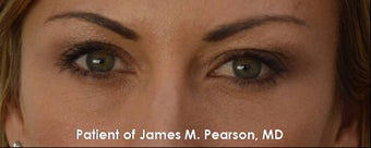 Lower Eyelid Rejuvenation (Tear Trough / Under Eye Hollows) after 959407