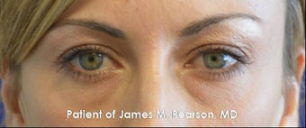 Lower Eyelid Rejuvenation (Tear Trough / Under Eye Hollows) before 959407