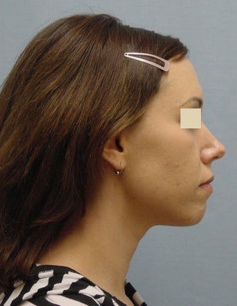 Chin Augments before 98008