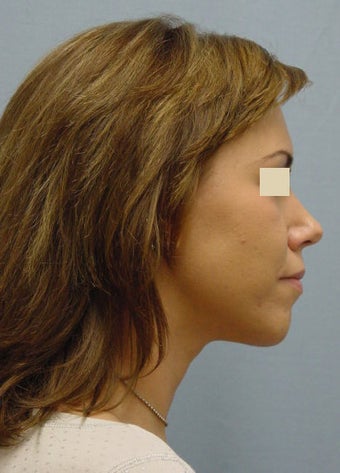 Chin Augments after 98008