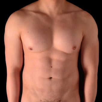 25-34 year old man treated with Liposculpture after 1943553