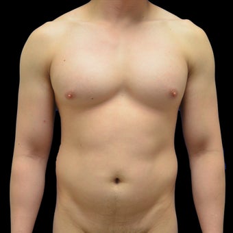 25-34 year old man treated with Liposculpture before 1943553