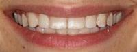 Bleaching and Fillings to Correct White Spots on Teeth before 913286