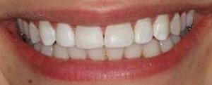 Bleaching and Fillings to Correct White Spots on Teeth after 913286