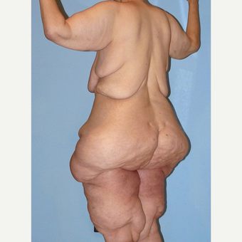 50 year old woman treated with Extreme Makeover Body Lift before 3629123