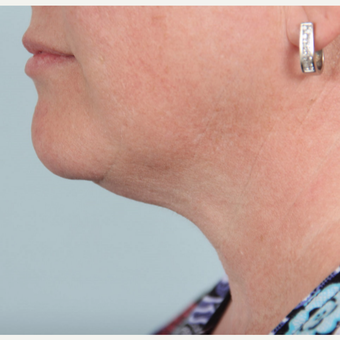 35-44 year old woman treated with two treatments of Kybella after 2712081