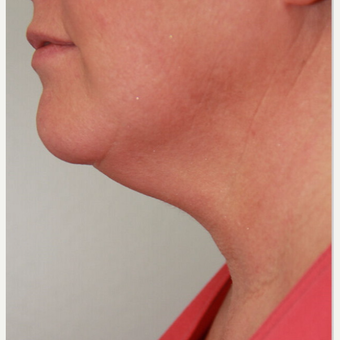 35-44 year old woman treated with two treatments of Kybella before 2712081