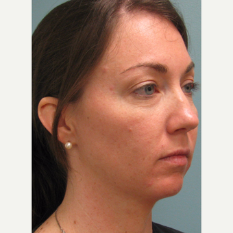 25-34 year old woman treated with Bellafill before 3142856