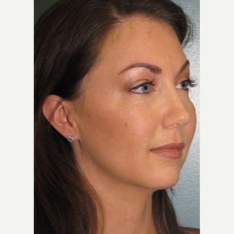 25-34 year old woman treated with Bellafill after 3142856