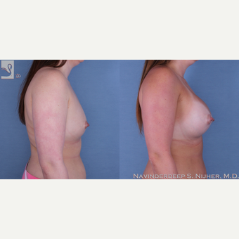 25-34 year old woman treated with Breast Augmentation-58955 after 3769824