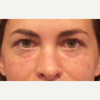 25-34 year old woman treated with Restylane after 3675107