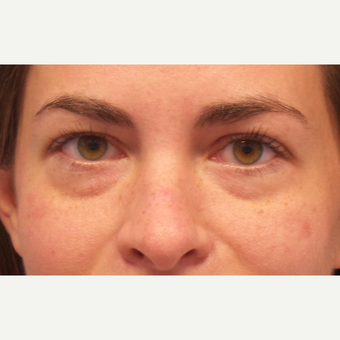 25-34 year old woman treated with Restylane before 3675107