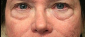 65-74 year old woman treated with Eyelid Surgery before 3046885
