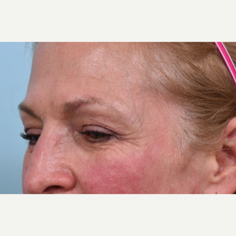 55 year old woman treated with Liquid Facelift before 3610789