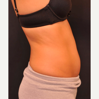 25-34 year old woman treated with SculpSure after 3844028