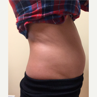 25-34 year old woman treated with SculpSure before 3844028