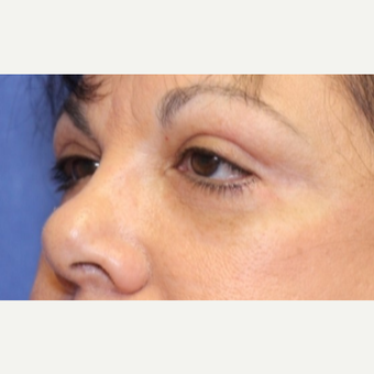 61 year old woman with Eyelid Surgery after 3774278