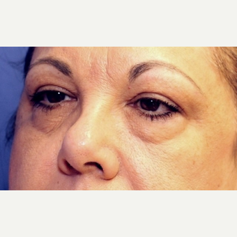61 year old woman with Eyelid Surgery before 3774278