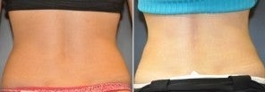 42 year old female, 60 days following 1 session of Cool Sculpting 1427458
