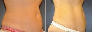 42 year old female, 60 days following 1 session of Cool Sculpting before 1427458