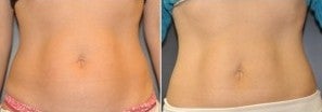 42 year old female, 60 days following 1 session of Cool Sculpting after 1427458