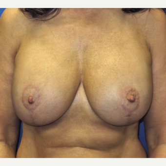 45-54 year old woman treated with Breast Lift with Implants after 3669581