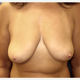 45-54 year old woman treated with Breast Lift with Implants before 3669581