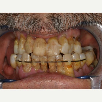 65-74 year old man treated with All-on-4 Dental Implants before 2180115