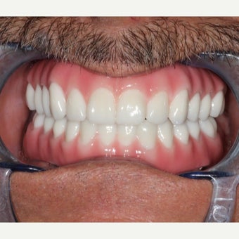 65-74 year old man treated with All-on-4 Dental Implants after 2180115