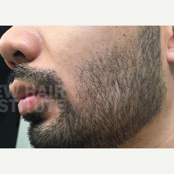 NONCOMP 25-34 year old man treated with FUE Hair Transplant Beard/ Facial Hair Transplant after 3108134