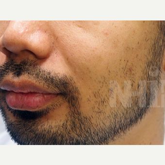 NONCOMP 25-34 year old man treated with FUE Hair Transplant Beard/ Facial Hair Transplant before 3108134