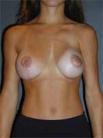 Breast Asymmetry Repaired with Implants and Mastopexy after 395020