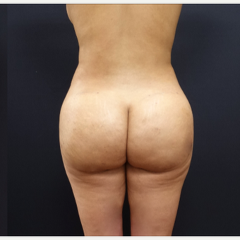 25-34 year old woman treated with Butt Augmentation after 3267009