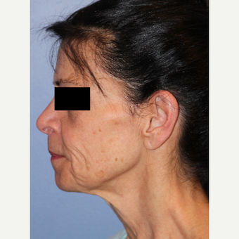 65-74 year old woman treated with Facelift, Fat Grafting, Fractional CO2 Laser, Facial Fillers before 3215286