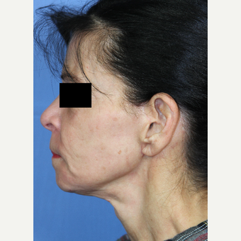 65-74 year old woman treated with Facelift, Fat Grafting, Fractional CO2 Laser, Facial Fillers after 3215286