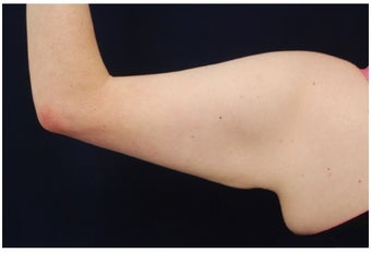 Arm Lift - Brachioplasty before 1071992