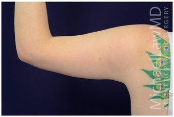 Arm Lift - Brachioplasty after 1071992