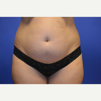 35-44 year old woman treated with Tummy Tuck before 3611036