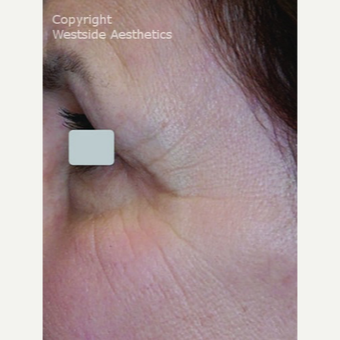 CO2 Laser for the Eye Area before 3075701