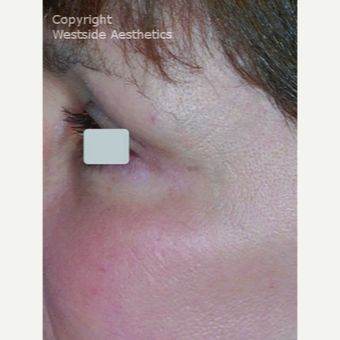 CO2 Laser for the Eye Area after 3075701