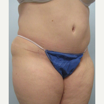 36 year old woman treated with Tummy Tuck after 3680173
