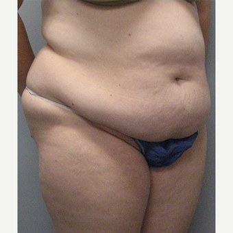 36 year old woman treated with Tummy Tuck before 3680173