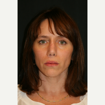 45-54 year old woman treated with Revision Rhinoplasty before 3649094