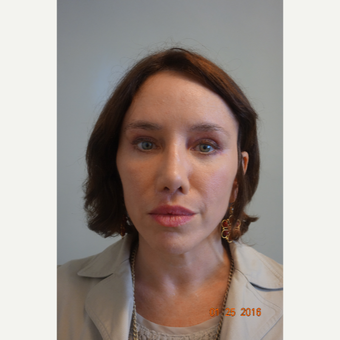 45-54 year old woman treated with Revision Rhinoplasty after 3649094