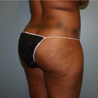 Brazilian Butt Lift before 3667400