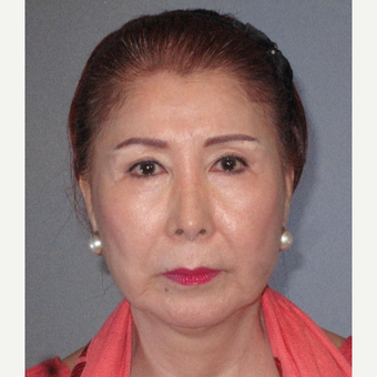 65-74 year old woman treated with Facelift before 3650749