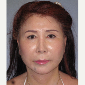 65-74 year old woman treated with Facelift after 3650749